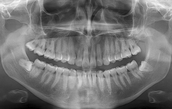 Wisdom Teeth Removal