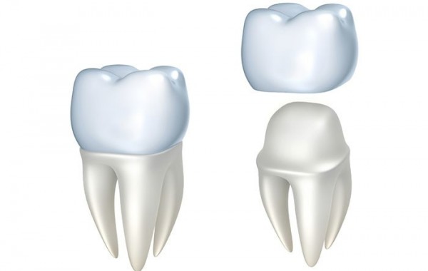 Crown Veneers and Bridges in Williams Landing