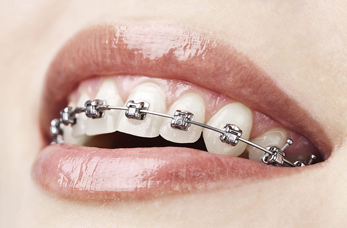 Patient with braces who comes to us for orthodontics in Truganina
