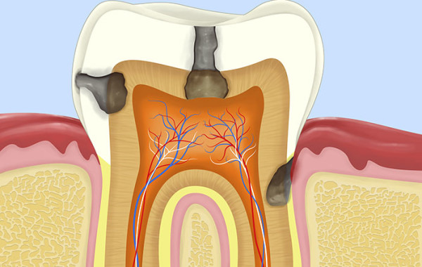 Root Canal Treatment